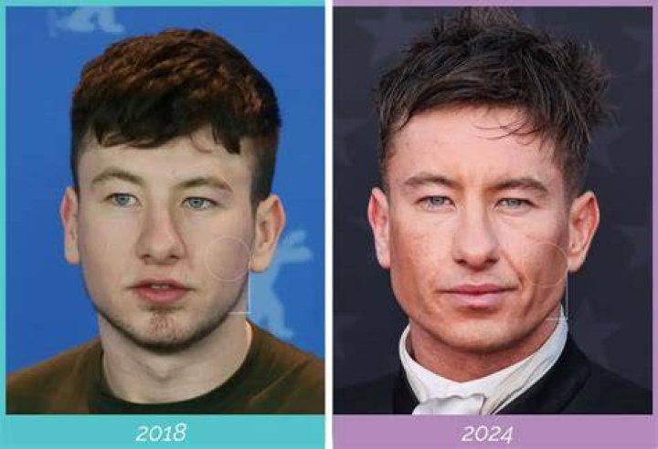 Barry Keoghan's Plastic Surgery: Before And After Transformation