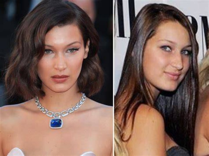 Bella Hadid Before and After Celebrity surgery, Celebrity plastic