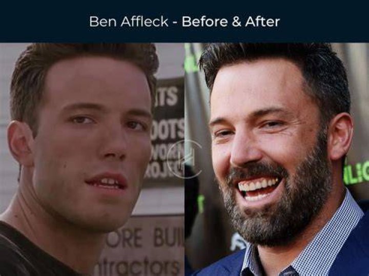 Ben Affleck's Dentures: A Hollywood Tale Of Smiles And Struggles