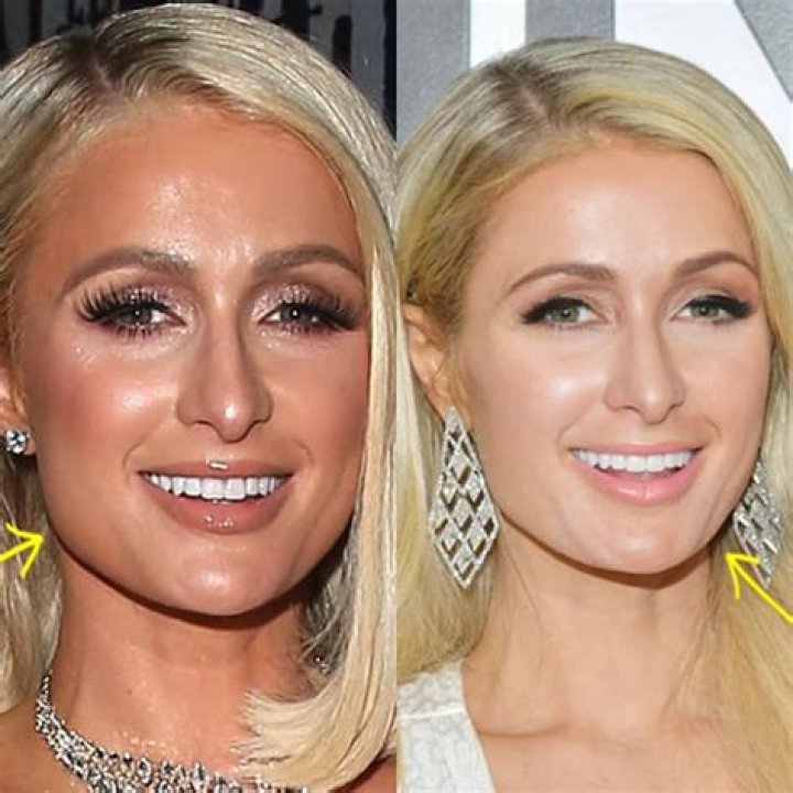 Did Paris Hilton Get Plastic Surgery? The Heiress’ Quotes about Botox