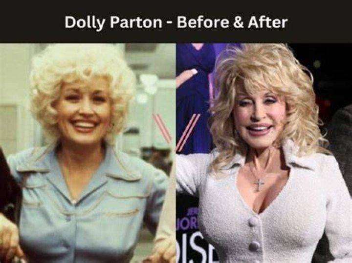 Dolly Parton Breast Implants Size Before & After Celebrity