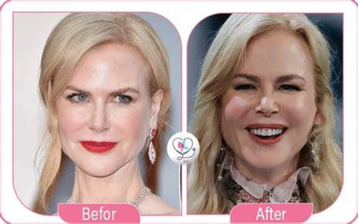 Has Nicole Kidman Undergone A Facelift? Examining The Evidence