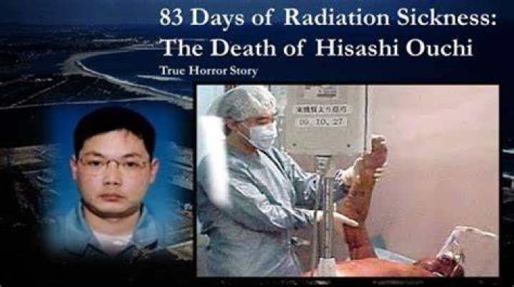 Hisashi Ouchi: A Haunting Reminder Of The Horrors Of Radiation