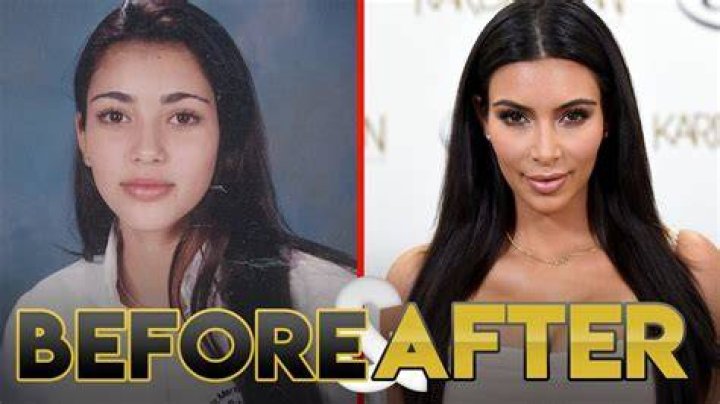 Kim Kardashian Before And After Plastic Surgery Timeline