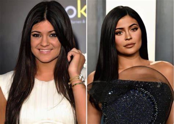 Kylie Jenner Before And After Plastic Surgery Photos