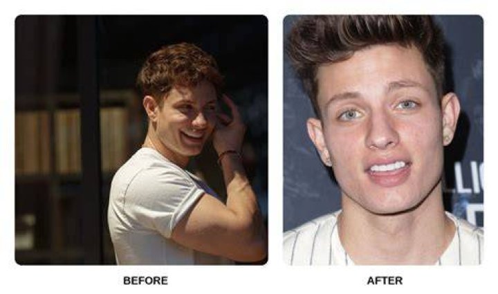 Matt Rife Before Fake Teeth Breaking News in USA Today