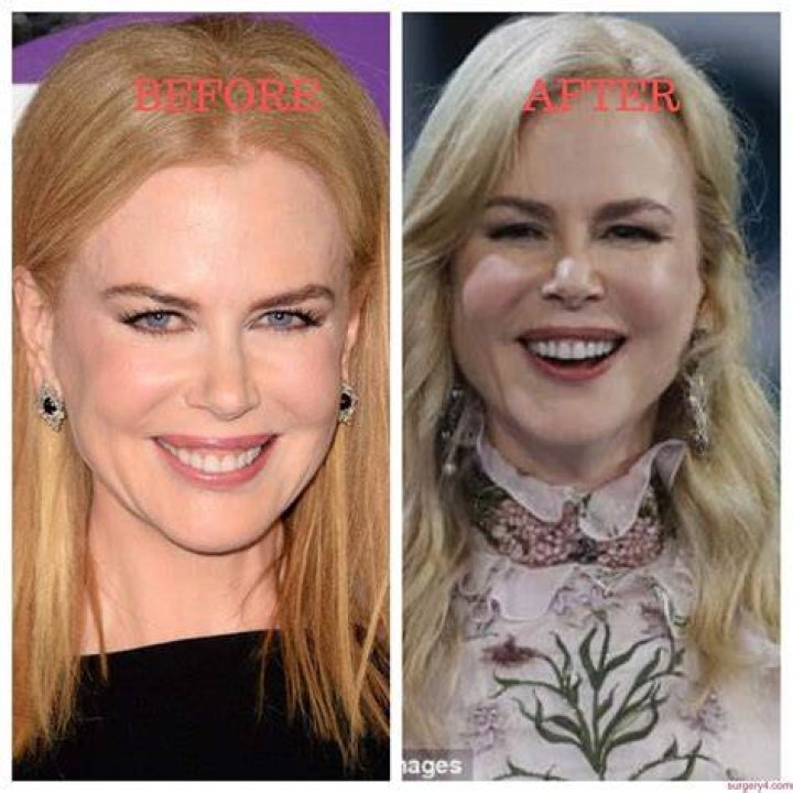 Nicole Kidman Plastic Surgery: Unveiling The Truth Behind The Speculations