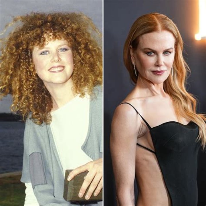 Nicole Kidman’s Plastic Surgery Transformation Top Docs Claim