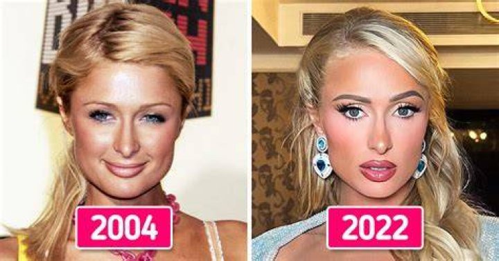Paris Hilton's Surprising Plastic Surgery Journey: Before And After Photos