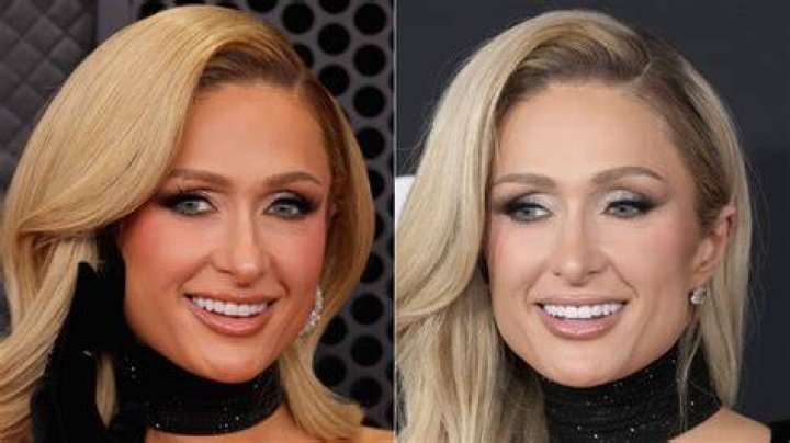 Stunning Transformation: Paris Hilton's Remarkable Nose Job Journey