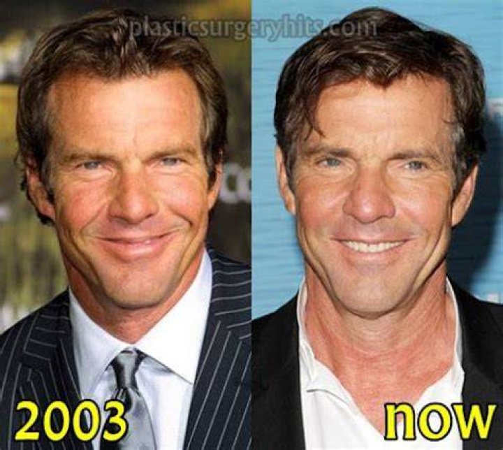 The Ultimate Guide To Dennis Quaid's Plastic Surgery: Enhancements And Controversies
