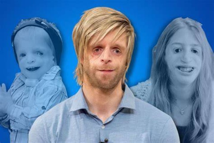 Uncovering The Extraordinary Lives Of Celebrities Living With Treacher Collins Syndrome