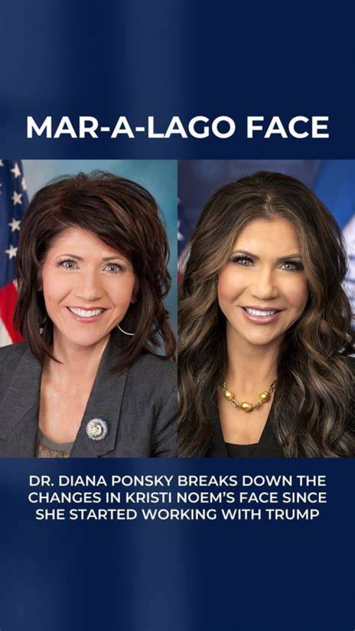 Unveiling Kristi Noem's Pre-Surgery Journey: Discoveries And Insights