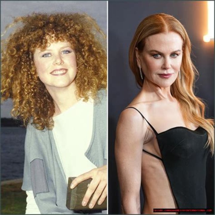 Witness Nicole Kidman's Face Surgery Transformation
